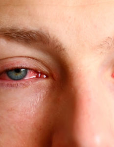 Causas de los ojos rojos: ojo rojo e irritado