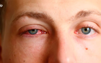 Causas de los ojos rojos: ojo rojo e irritado