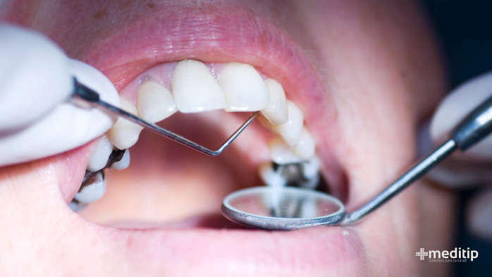 Dolor de dientes por empastes dentales dañados