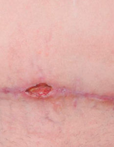 Dehiscencia de heridas: abertura de incisión o herida quirúrgica
