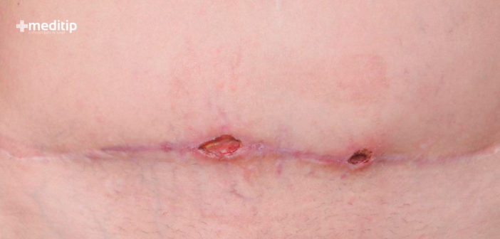 Dehiscencia De Heridas Abertura De La Incision Quirurgica Meditip