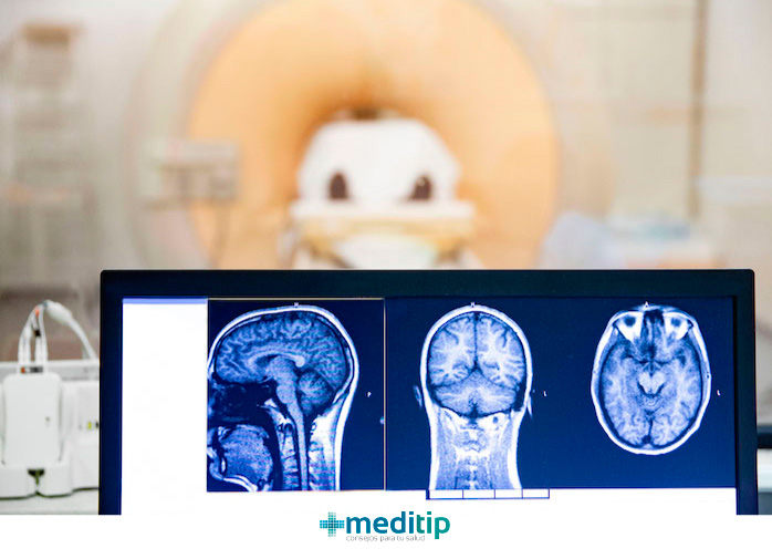 Diagnóstico de la epilepsia: resonancia magnética del cerebro después de una convulsión