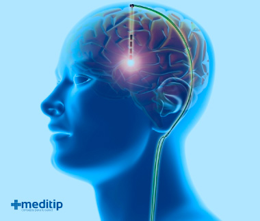 Tratamiento de la epilepsia: estimulación cerebral profunda