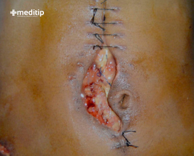 Por qué ocurre la dehiscencia de heridas: tipo incorrecto de sutura o mala suturación