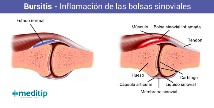 Qué es la bursitis: inflamación de las bolsas sinoviales puede causar bursitis en el adulto mayor