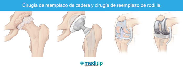 Cirugías de ortopedia más comunes: prótesis de cadera y prótesis de rodilla