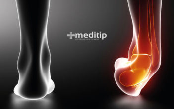 Tratamiento de un esguince: esguince de tobillo