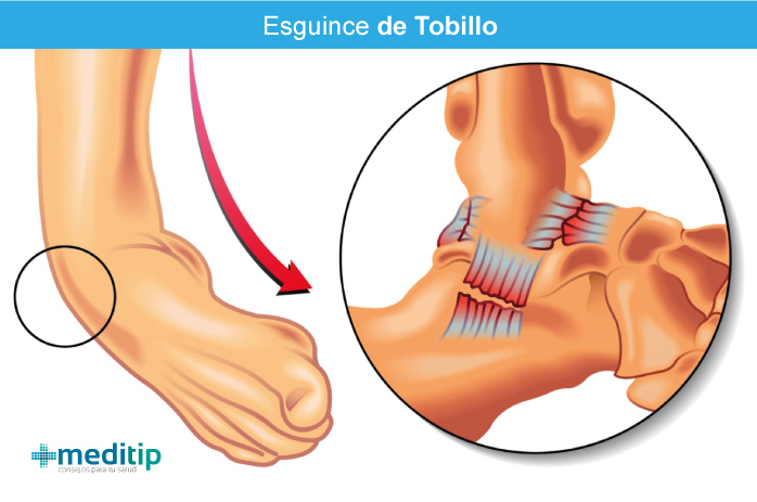 Esguince de Tobillo: Que es y como Tratarlo - Ortopedia 41 en Madrid