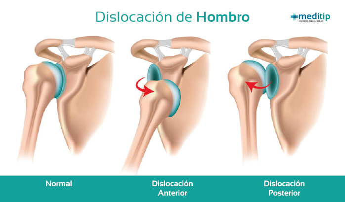 Ilustración de dislocación de hombro: tipos de dislocación