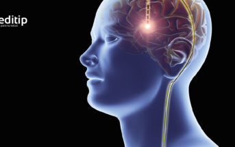 Tratamiento de la epilepsia: estimulación del nervio vago