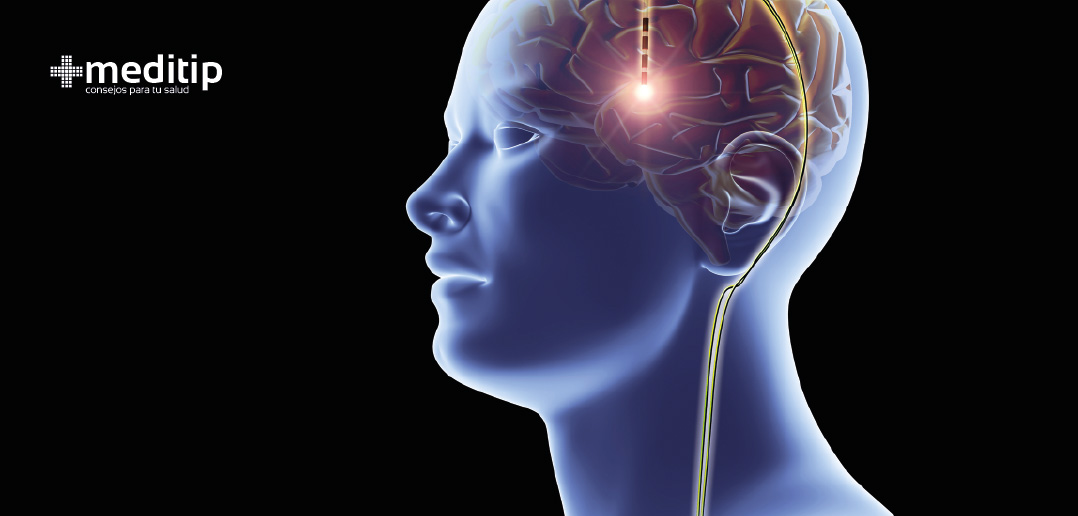 Tratamiento de la epilepsia: estimulación del nervio vago