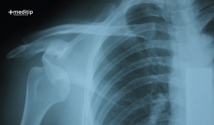 Radiografía de una dislocación de hombro 