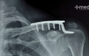 Cirugía de fusión de hombro