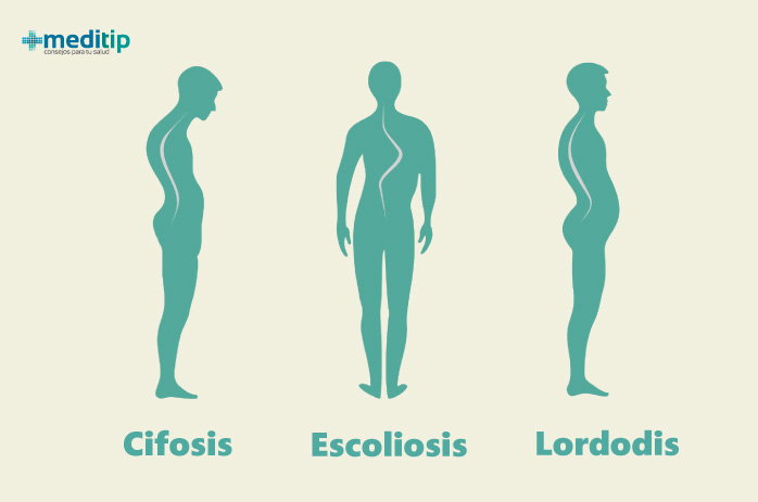 Ilustración de hipercifosis, escoliosis e hiperlordosis
