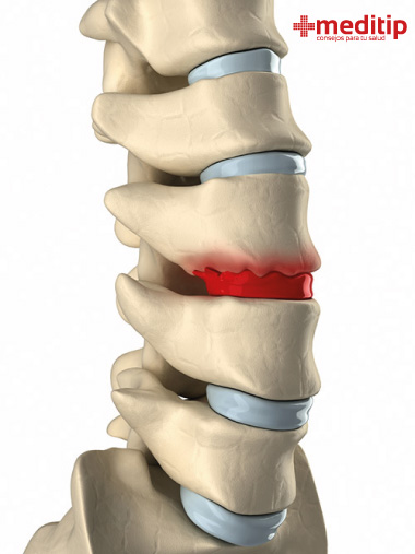 Disco vertebral degenerado: causas más recurrentes del dolor de espalda