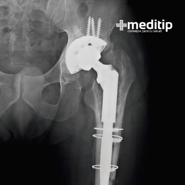 Cirugías de ortopedia más comunes: revisión de prótesis de cadera