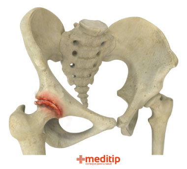 Daño en la cadera debido a osteoartritis: función de la cirugía de reemplazo de cadera