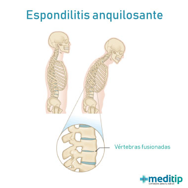 Ilustración de Espondilitis anquilosante
