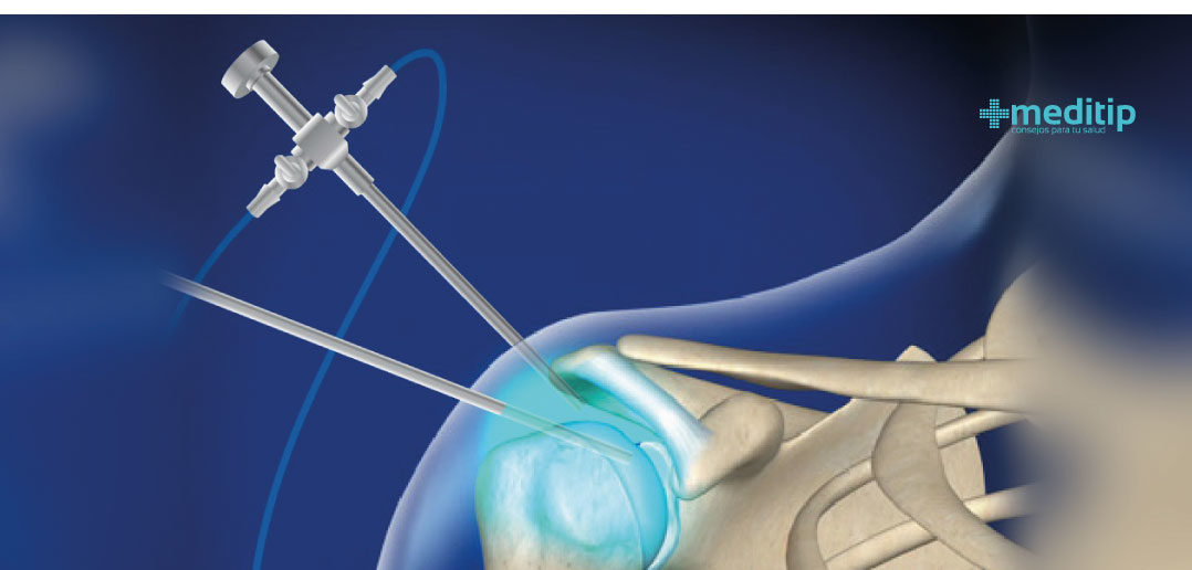 Beneficios de la artroscopia: cirugía artroscópica de hombro