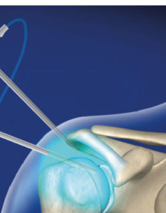 Beneficios de la artroscopia: cirugía artroscópica de hombro