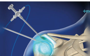 Beneficios de la artroscopia: cirugía artroscópica de hombro