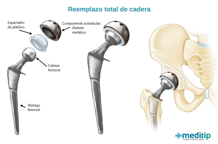 Ilustración de una cirugía de reemplazo total de cadera