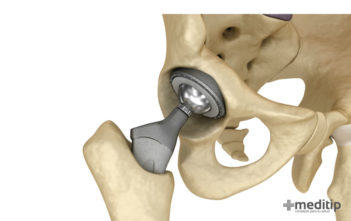 En qué consiste la cirugía de reemplazo total de cadera