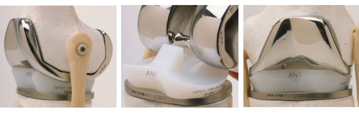 Vistas de una prótesis de rodilla: durabilidad, beneficios de una prótesis ortopédica