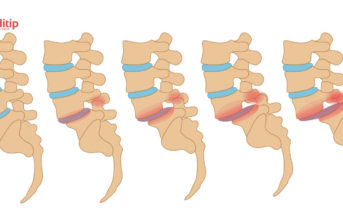 Proceso y grados de deslizamiento de una vértebra