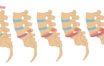 Proceso y grados de deslizamiento de una vértebra