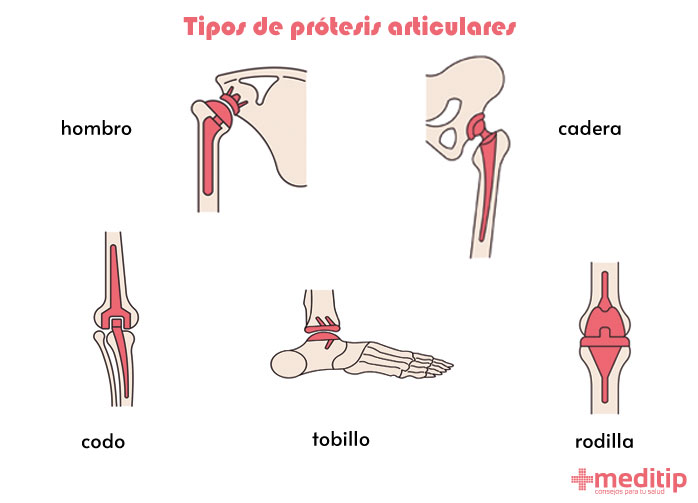 Ilustración: tipos de prótesis de articulaciones