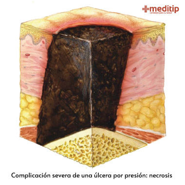 Complicaciones de las úlceras por presión: tejido necrótico que requiere desbridamiento