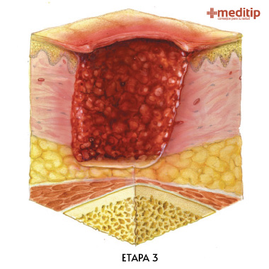 Etapa tres de una úlcera por presión: cuidado y uso de apósitos para el tratamiento de la herida