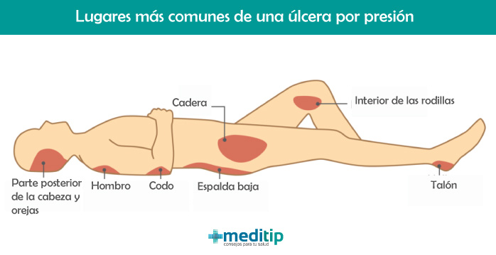 Úlceras por presión más comunes: cadera, espalda baja, codo, hombros, talón, parte posterior de la cabeza e interior de las rodillas