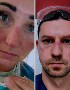 Heridas por uso de equipo de protección sanitaria: Lesiones faciales en profesionales de la salud