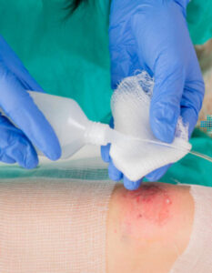 La limpieza de heridas es el primer paso para apoyar la cicatrización