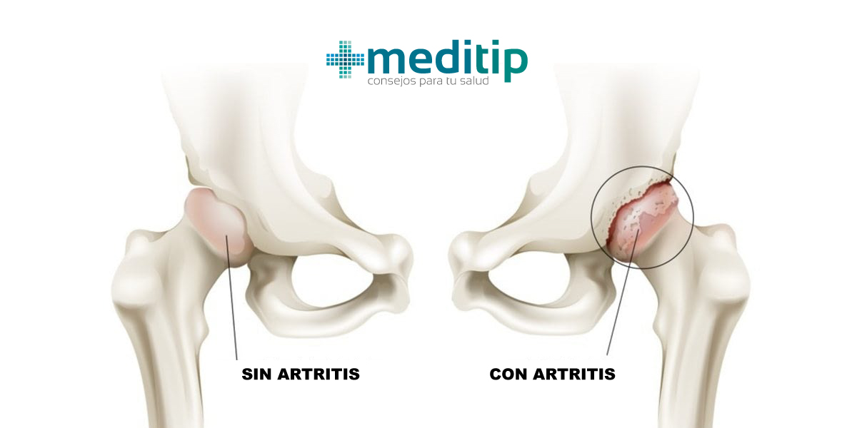La artritis es un factor que puede provocar una lesión en la cadera