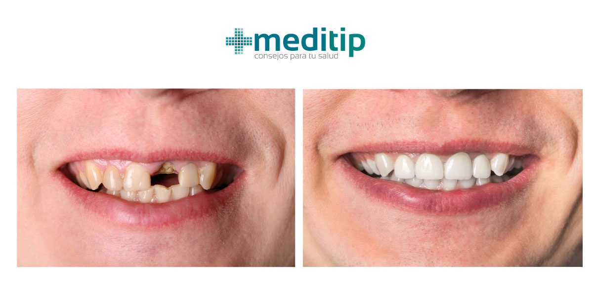 Tanto la pérdida ósea como el desplazamiento de los dientes causado por la pérdida de los dientes pueden afectar la apariencia de tu rostro.