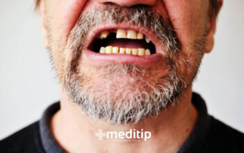 Consecuencias de la pérdida de dientes