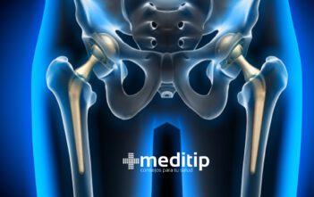 Qué es la dislocacion