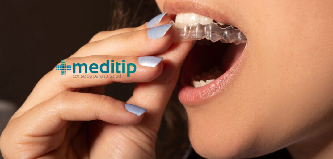Los alineadores dentales están hechos de delgadas carcasas de plástico diseñadas para empujar los dientes a su posición gradualmente cuando se usan de manera constante
