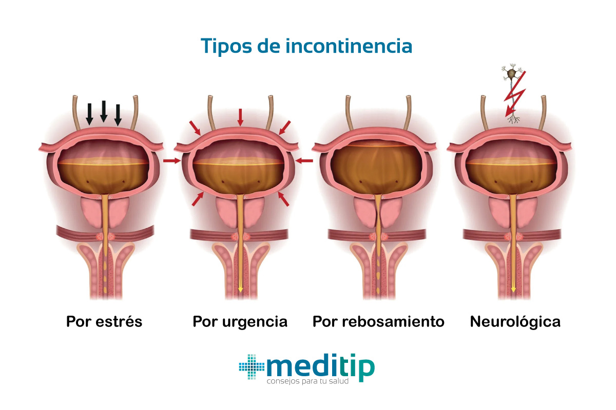 Descripción de los tipos de incontinencia urinaria