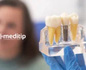 Beneficios Estéticos y Funcionales de los Implantes Dentales