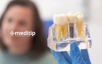 Beneficios Estéticos y Funcionales de los Implantes Dentales