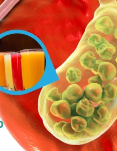 Piedras en la Vesícula: Alimentos y Bebidas para Eliminarlas y Prevenirlas