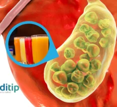 Piedras en la Vesícula: Alimentos y Bebidas para Eliminarlas y Prevenirlas