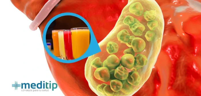 Piedras en la Vesícula: Alimentos y Bebidas para Eliminarlas y Prevenirlas